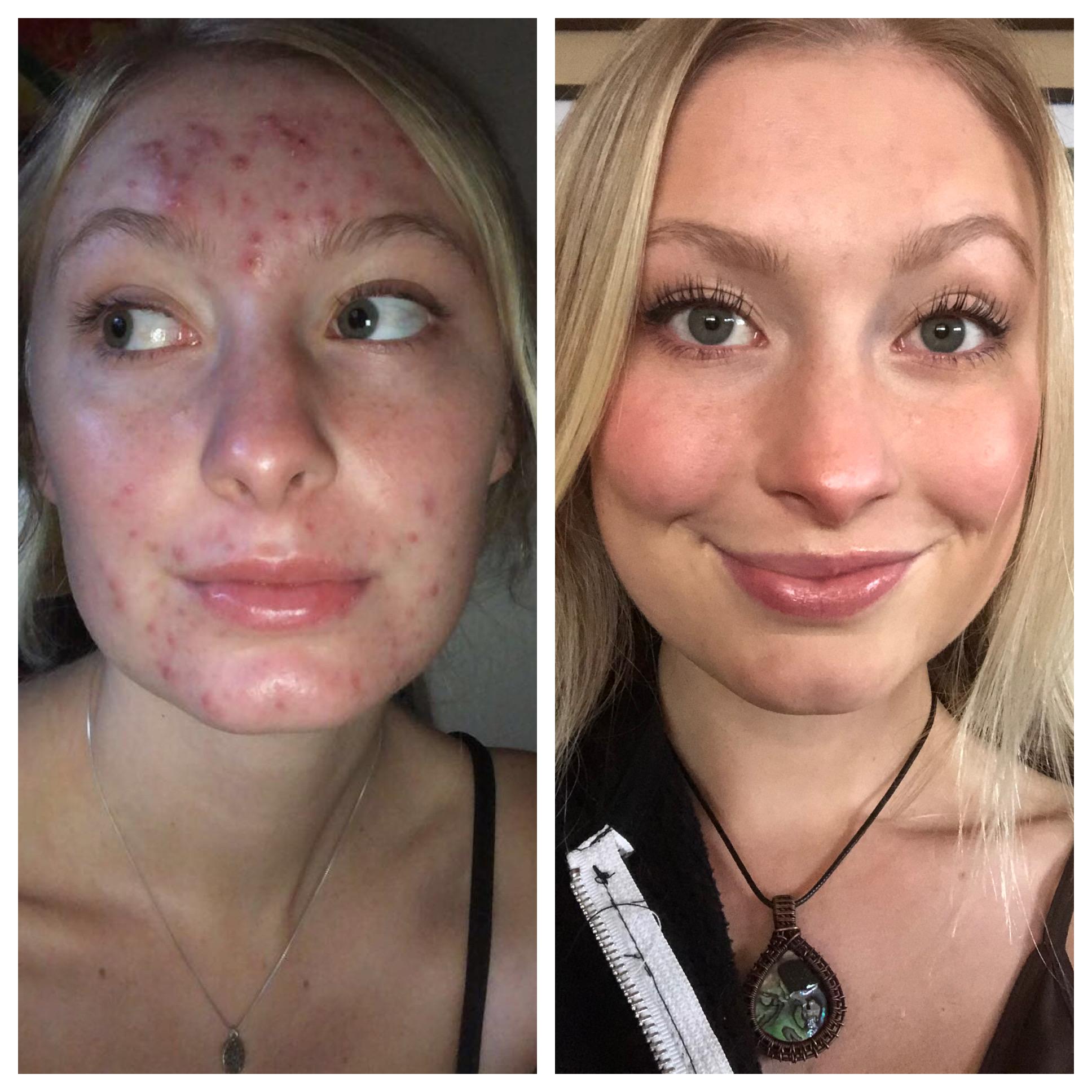 2845 best r/accutane images on pholder