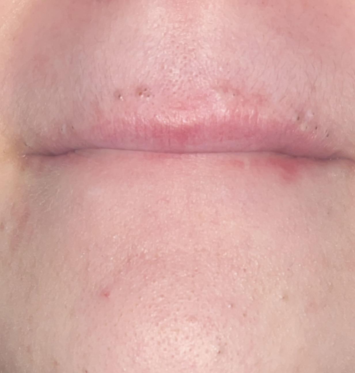 Punti neri ricorrenti intorno alle labbra? : rSkincare_Addiction