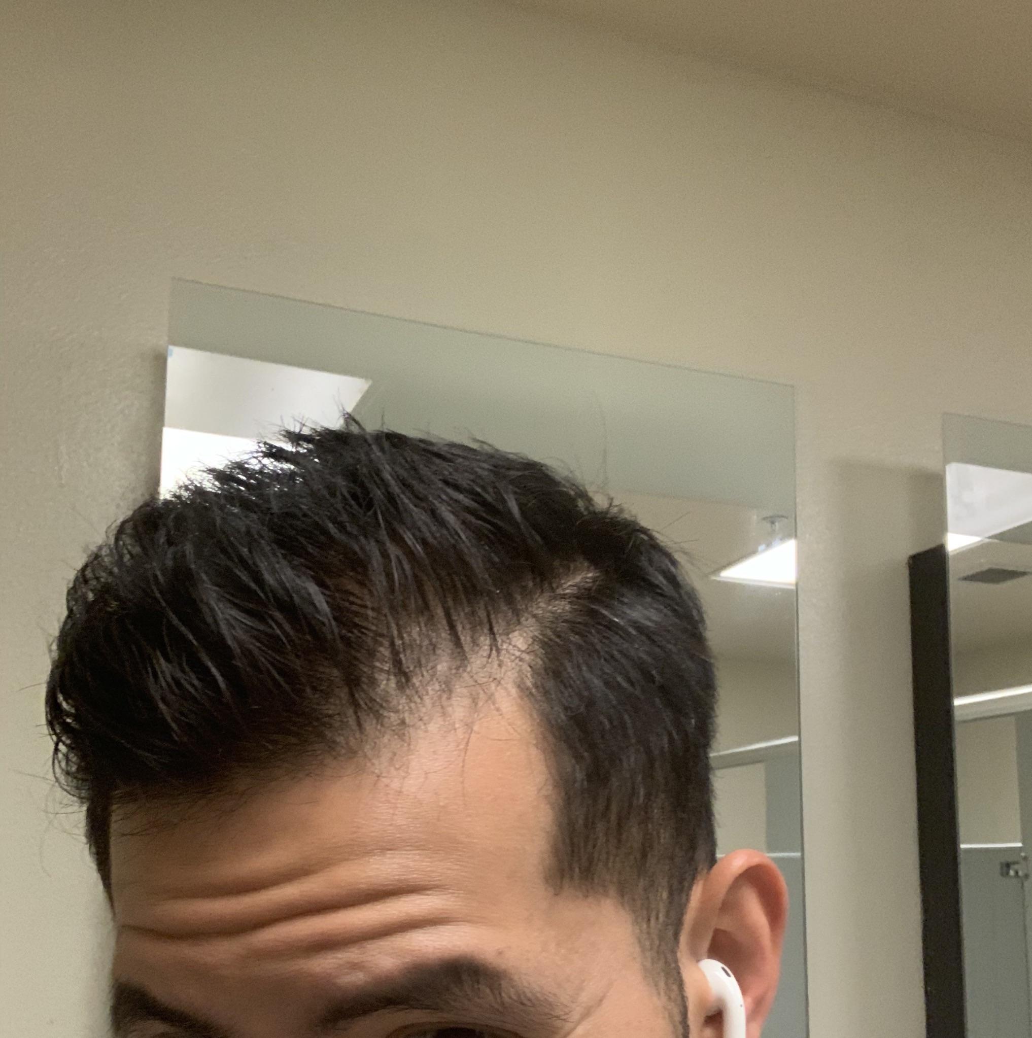 Thin hair/ receding hairline