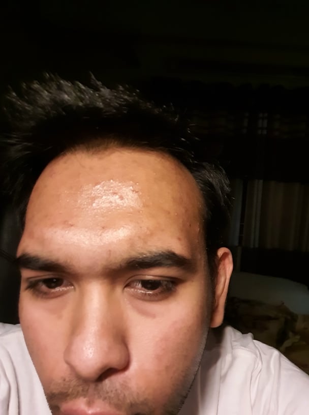 37+ Unique Treating Blind Pimples - Mario Badesco Update - Paperblog - They can be extremely painful, and can make activities like eating, drinking and talking unbearable.