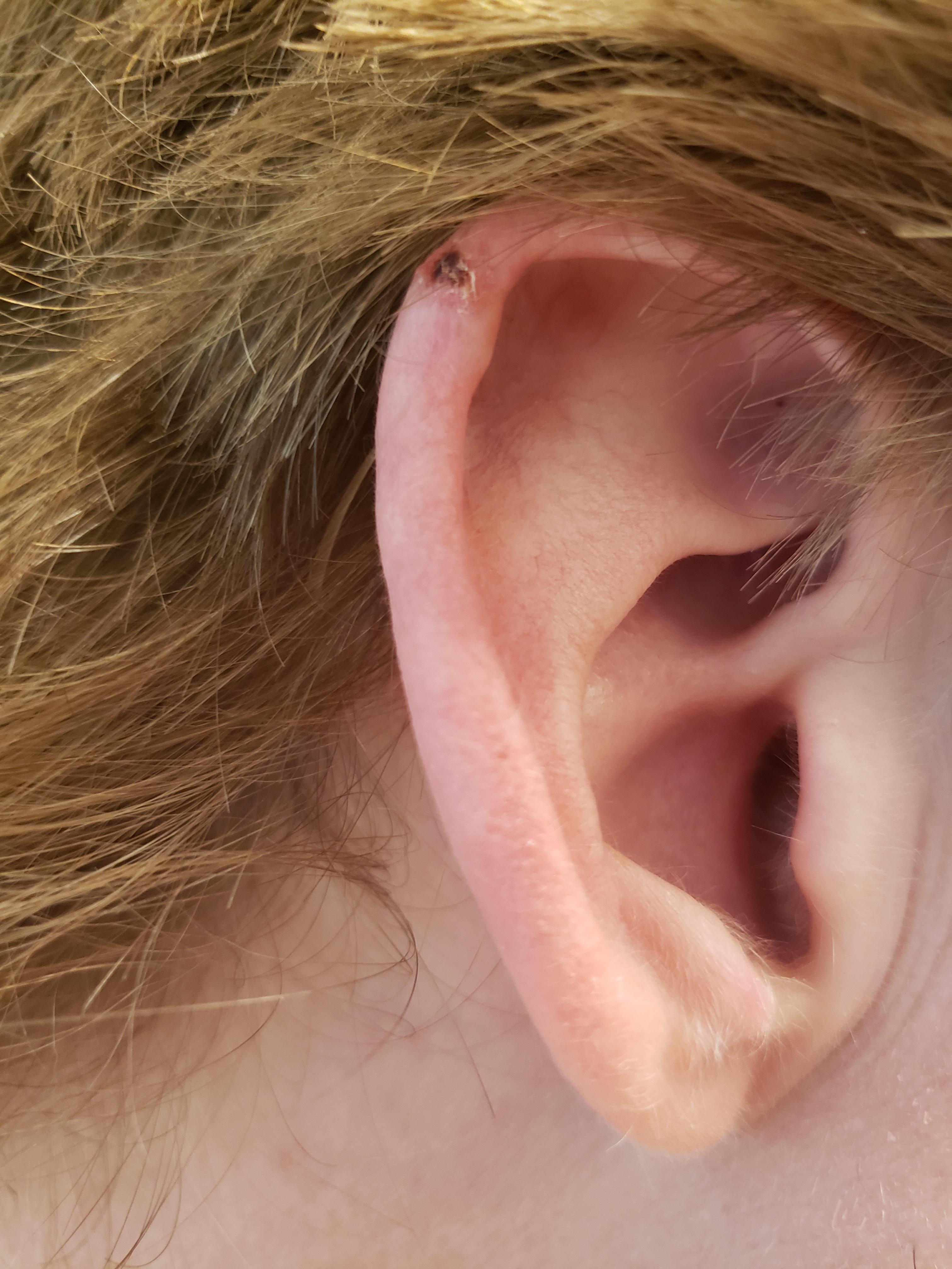 I nicked my upper ear cartilage over 1 month ago with electric clippers  while trimming my hair : rmildlyinteresting