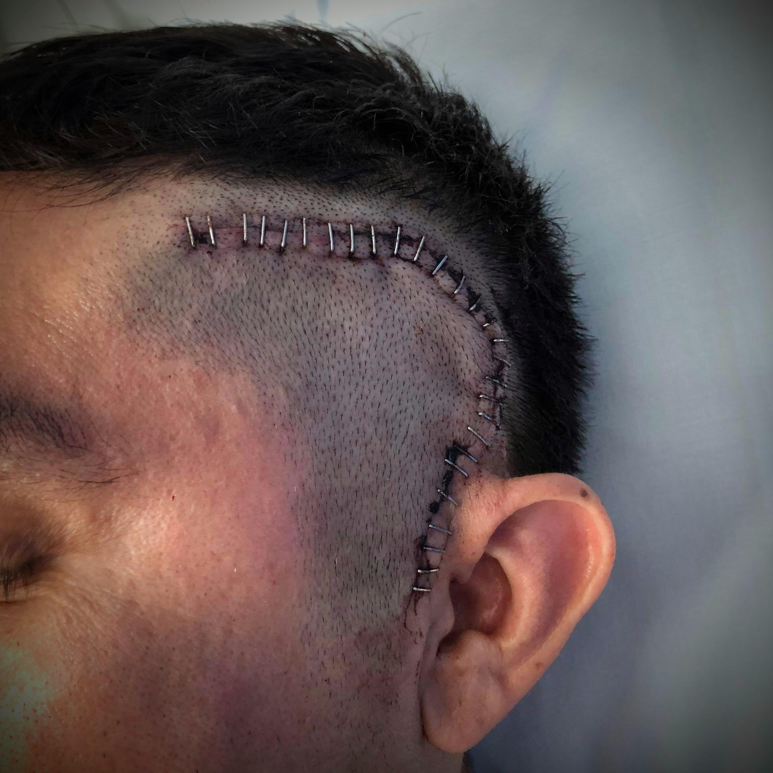 photo Staples In Head man with staples in head no sob story