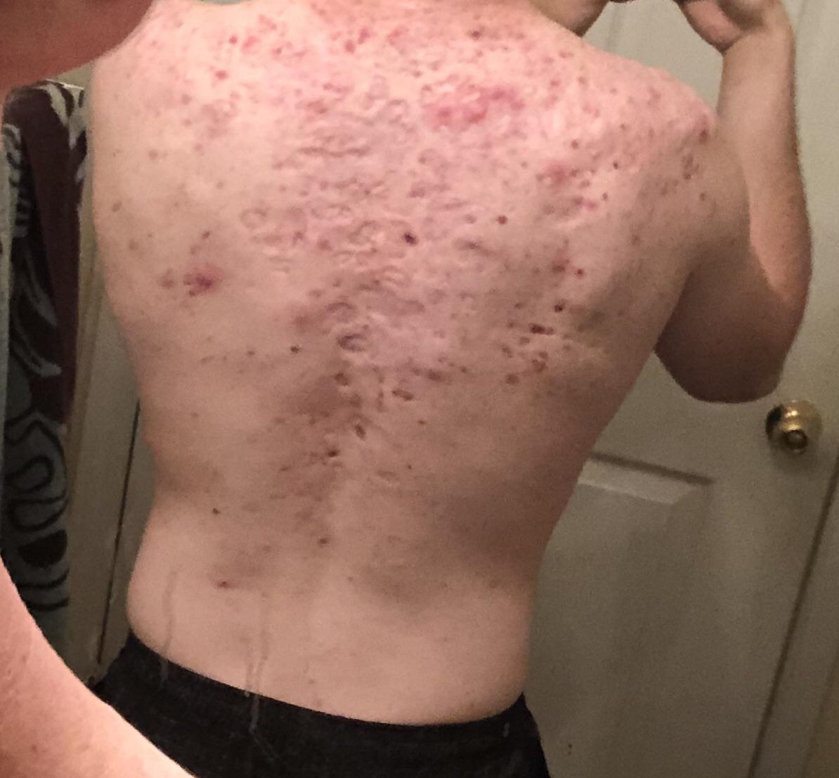 Scars Remaining From Acne Conglobata 3 Years Post Accutane Cycle Acne
