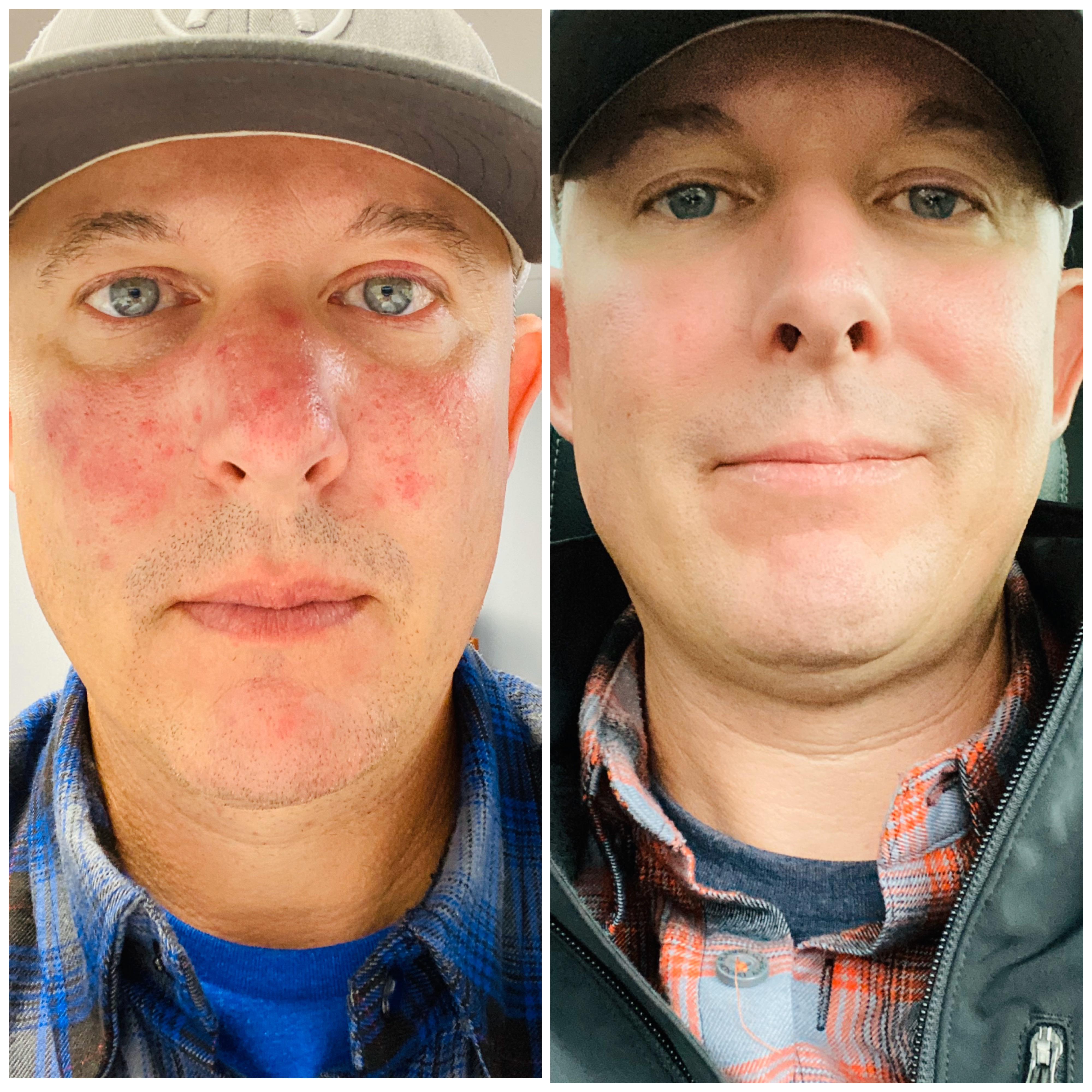 2698 best r/accutane images on pholder