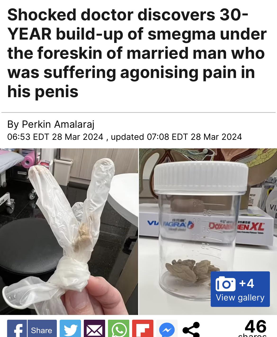 Shocked doctor discovers 30-YEAR build-up of smegma under the foreskin of  married man who was suffering agonising pain in his penis : rnope