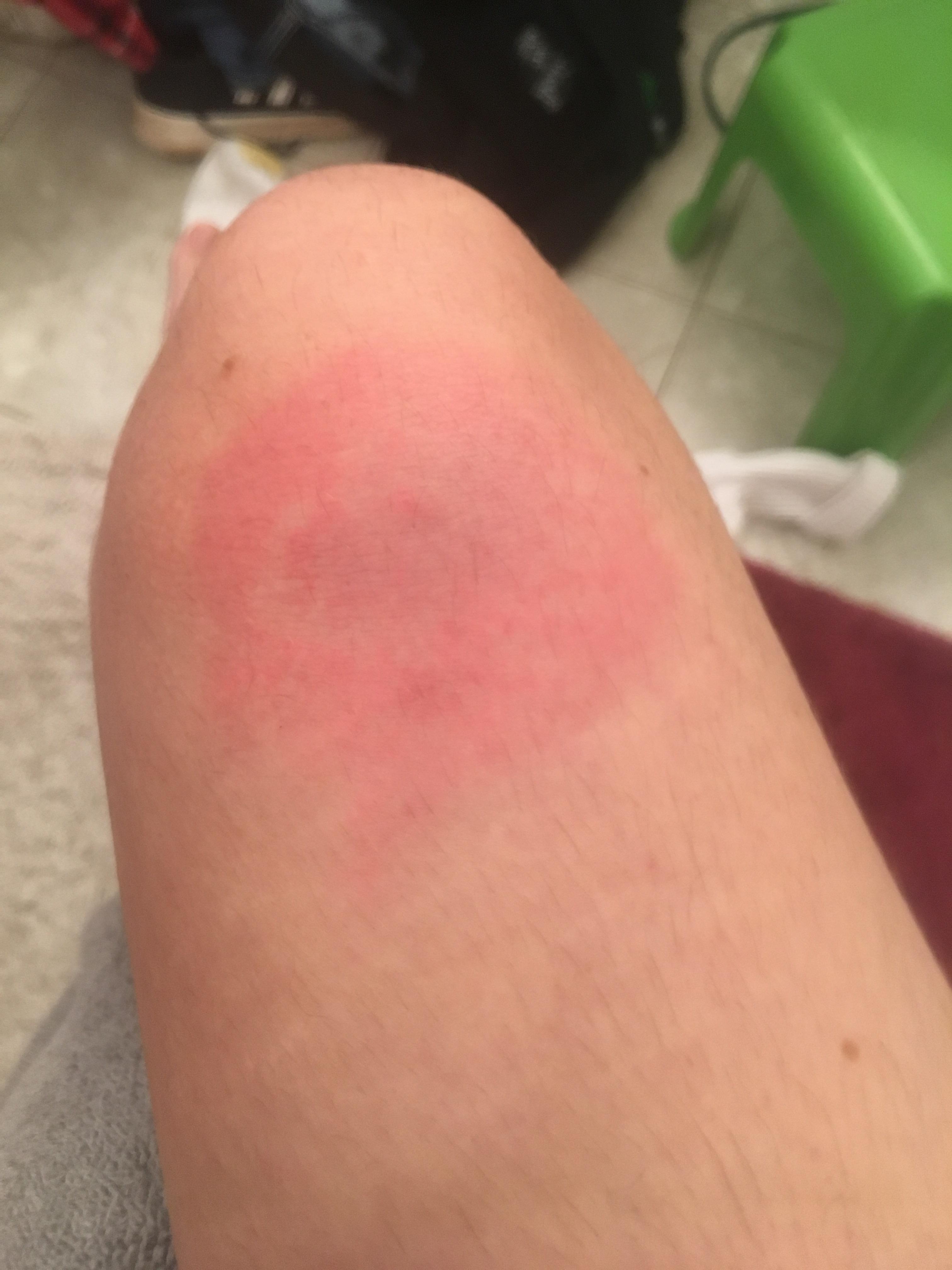 The allergic reaction call is a face painters most dreaded call. Allergic to mosquito bites. Is there anything i could do