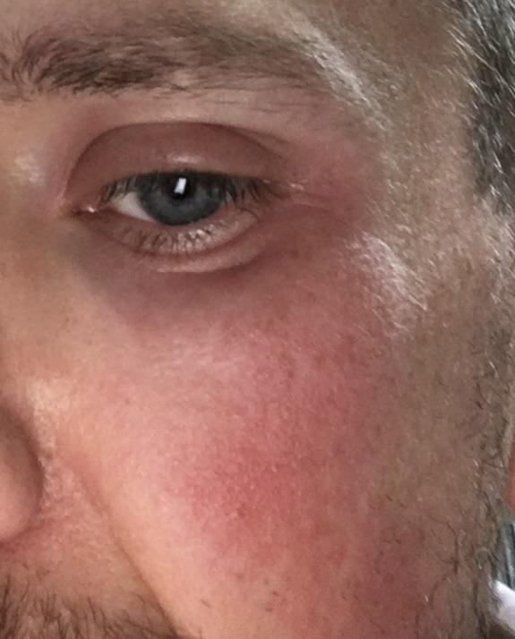 23+ Images Of Shingles Around The Eye Pictures