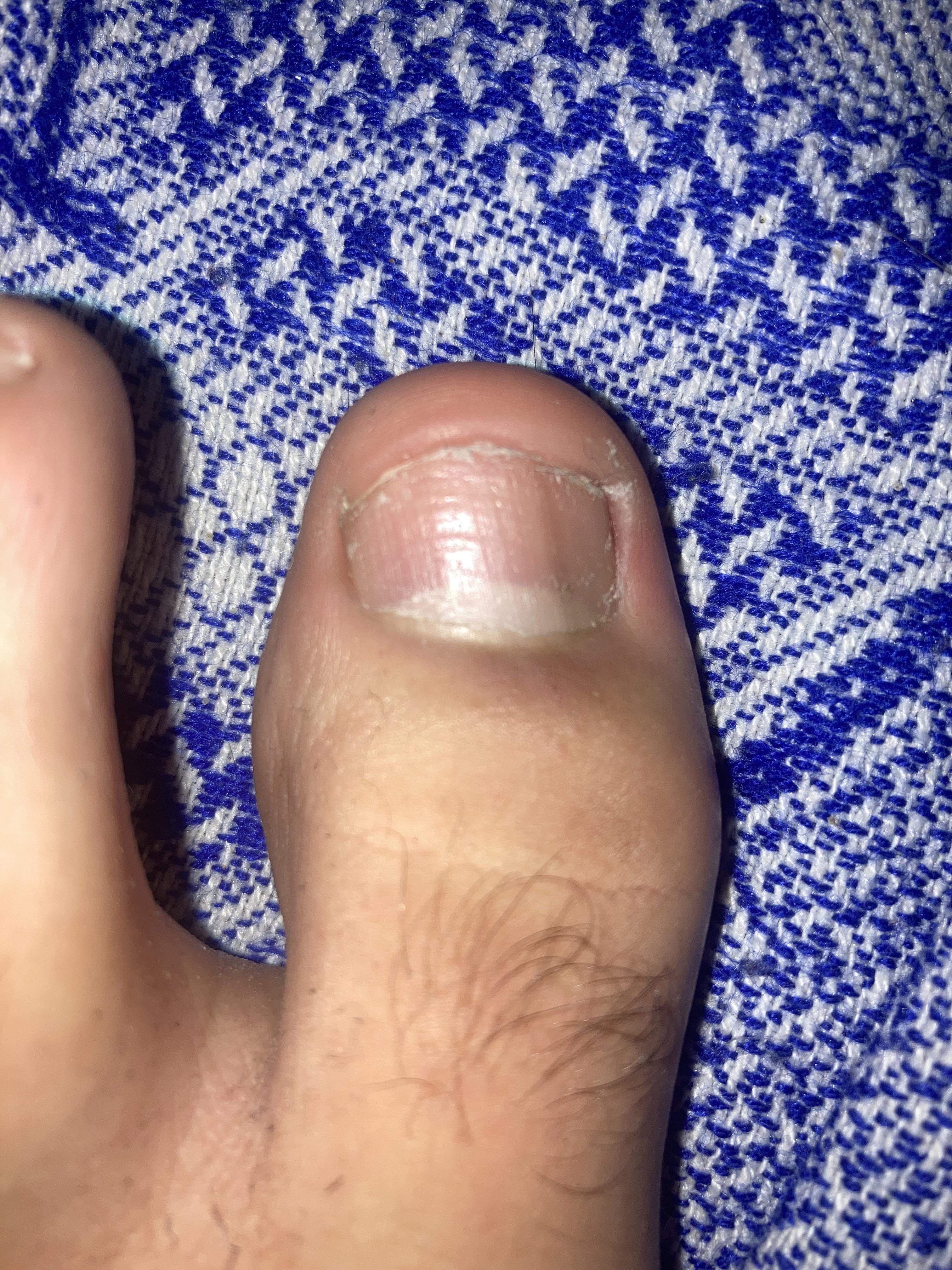 Line on toe nail