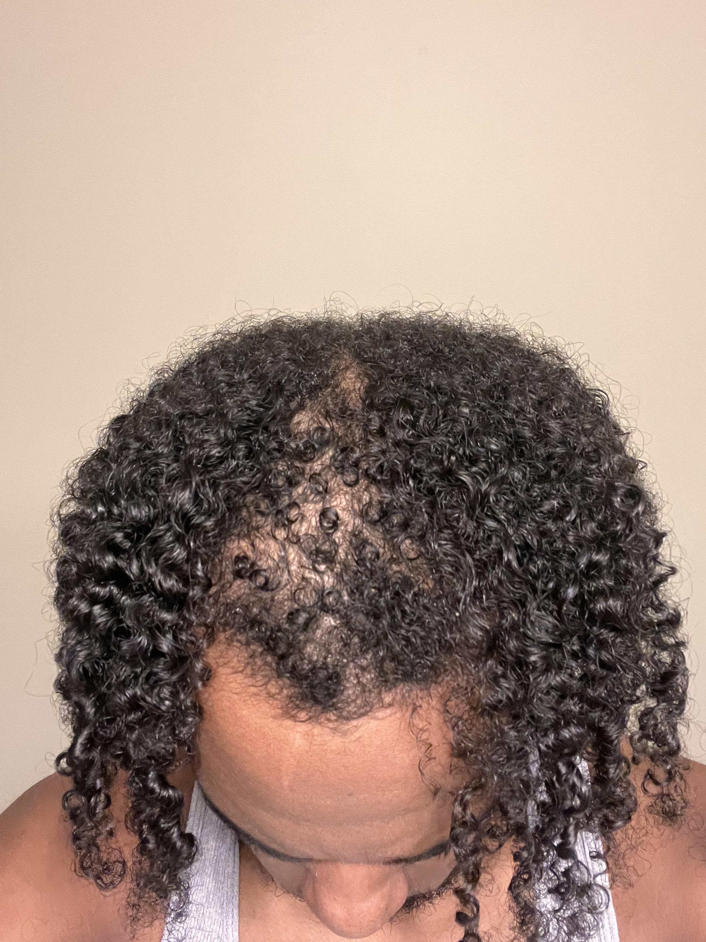 I wore cornrows for months at a time over nearly 2 years but left them out  for the past 4 months. After the last time I undid them, I had a patch