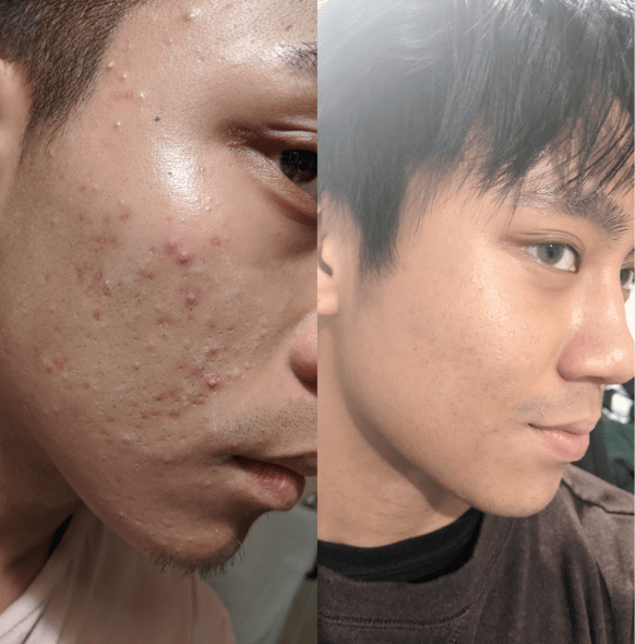 A place to discuss beauty brands, cosmetics, and skincare . 5905 Best R Asianbeauty Images On Pholder Fotd Followup 9 Month Progress Update And Next Steps