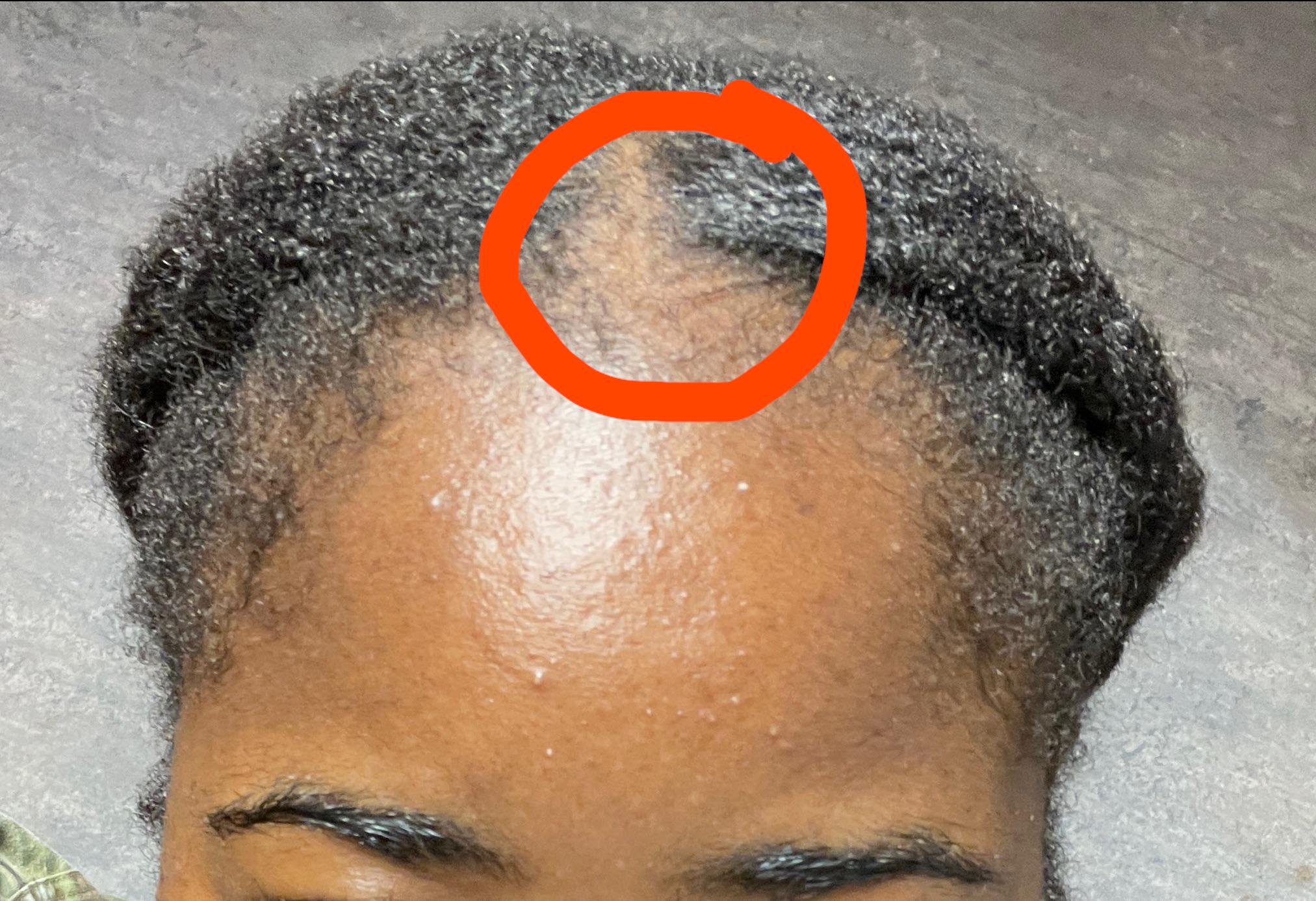 Bald spot treatment recommendations plz! : rNaturalhair