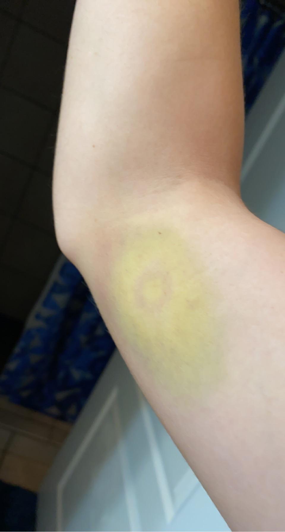 Is paintball too dangerous for kids and can it cause bruises and injuries. My Bruise From Paintball Looks Like An Avocado R Mildlyinteresting