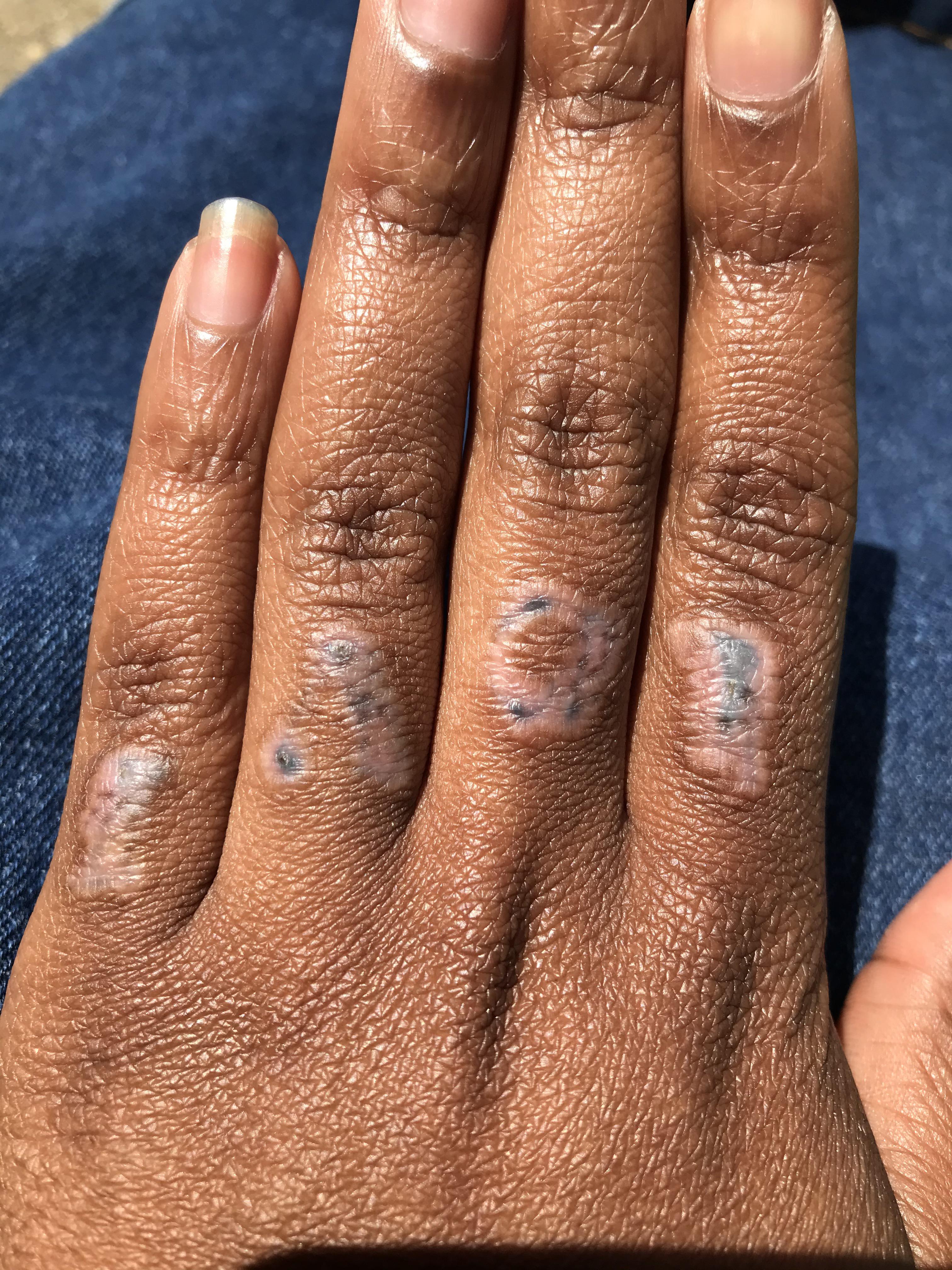 Is This Hypopigmentation? :'( : R/Tattooremoval 4032_x_3024_jpg