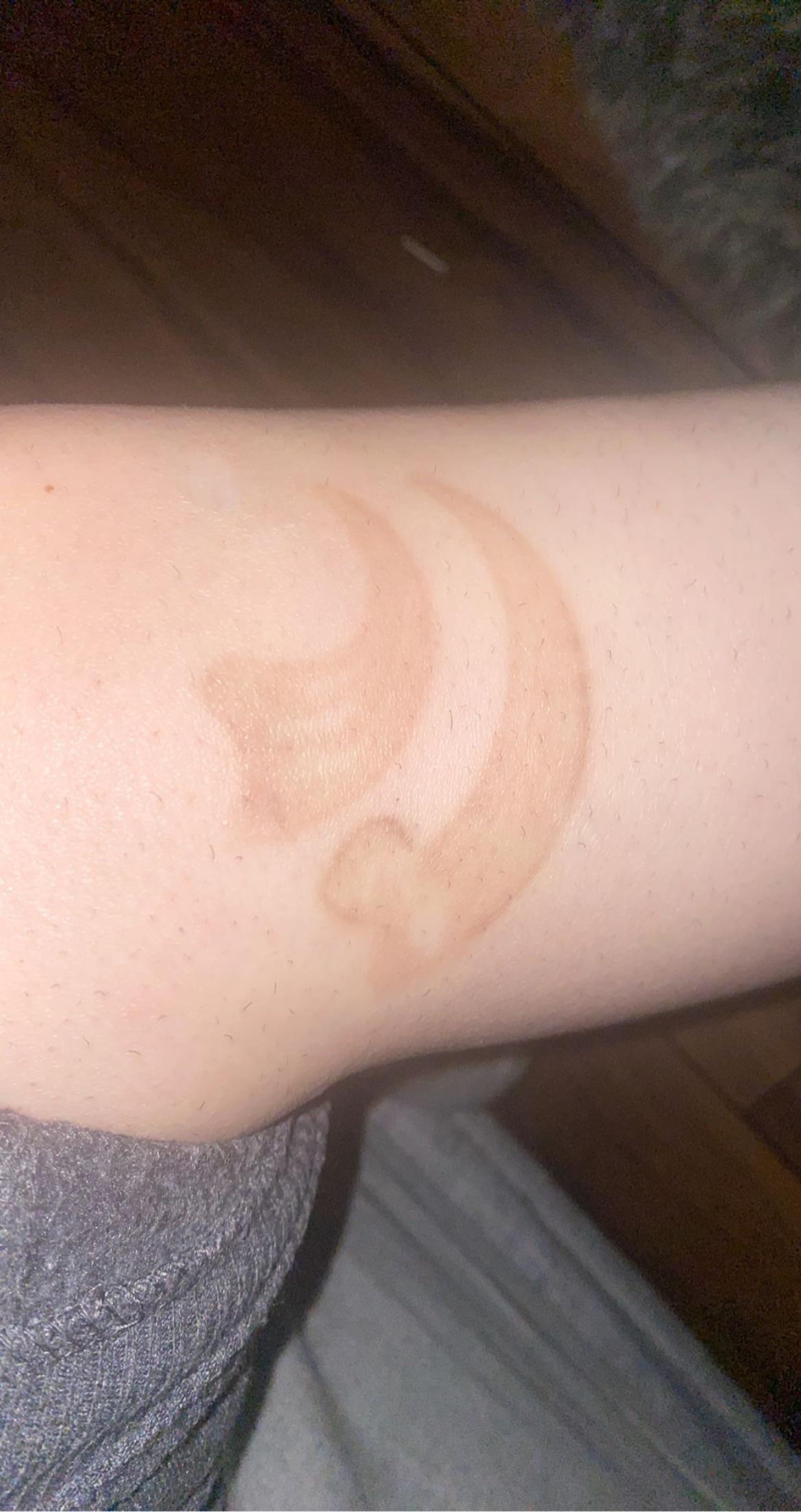 Neatcell tattoo removal?