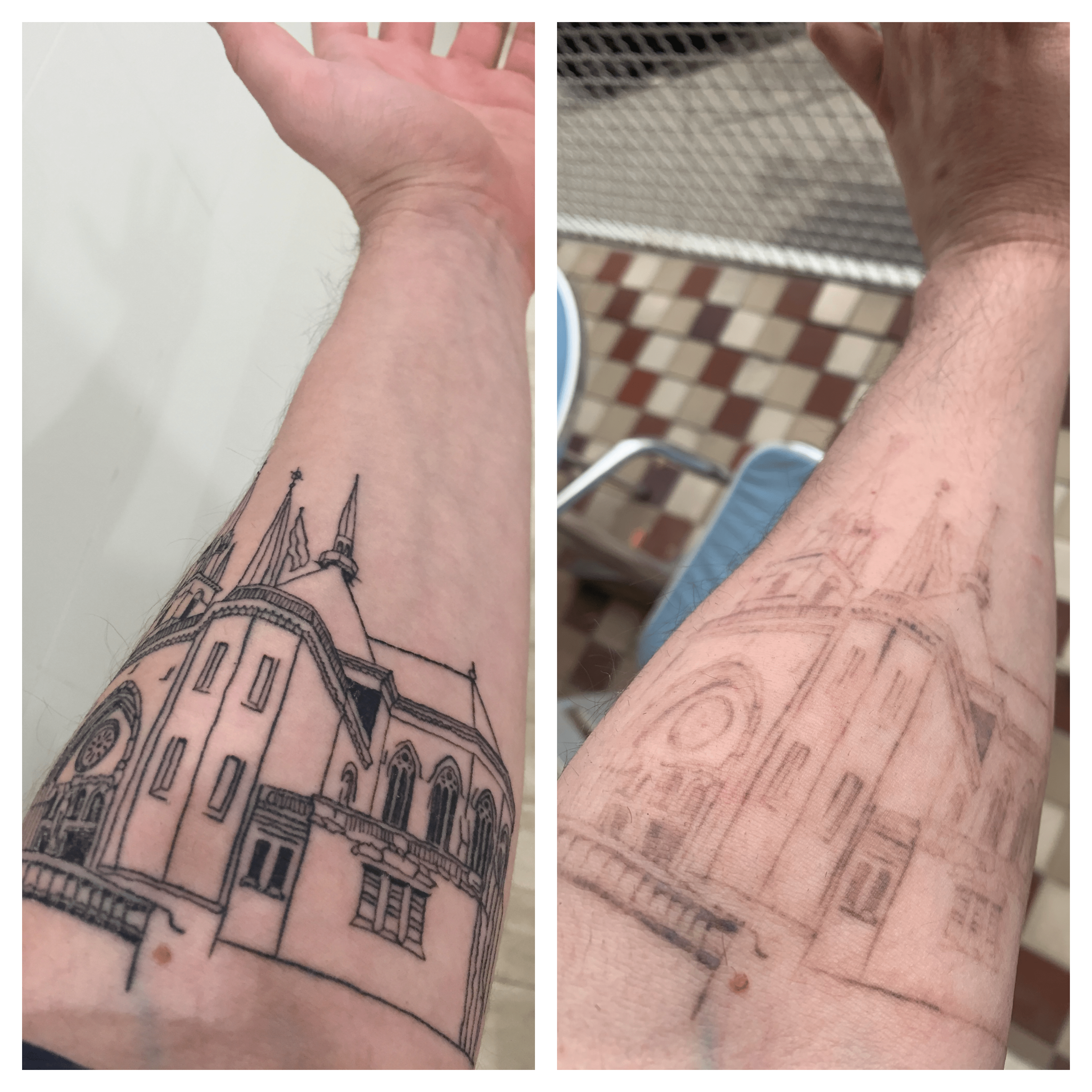 Just Wanted To Share My Progress 1 Year Comparison Tattooremoval