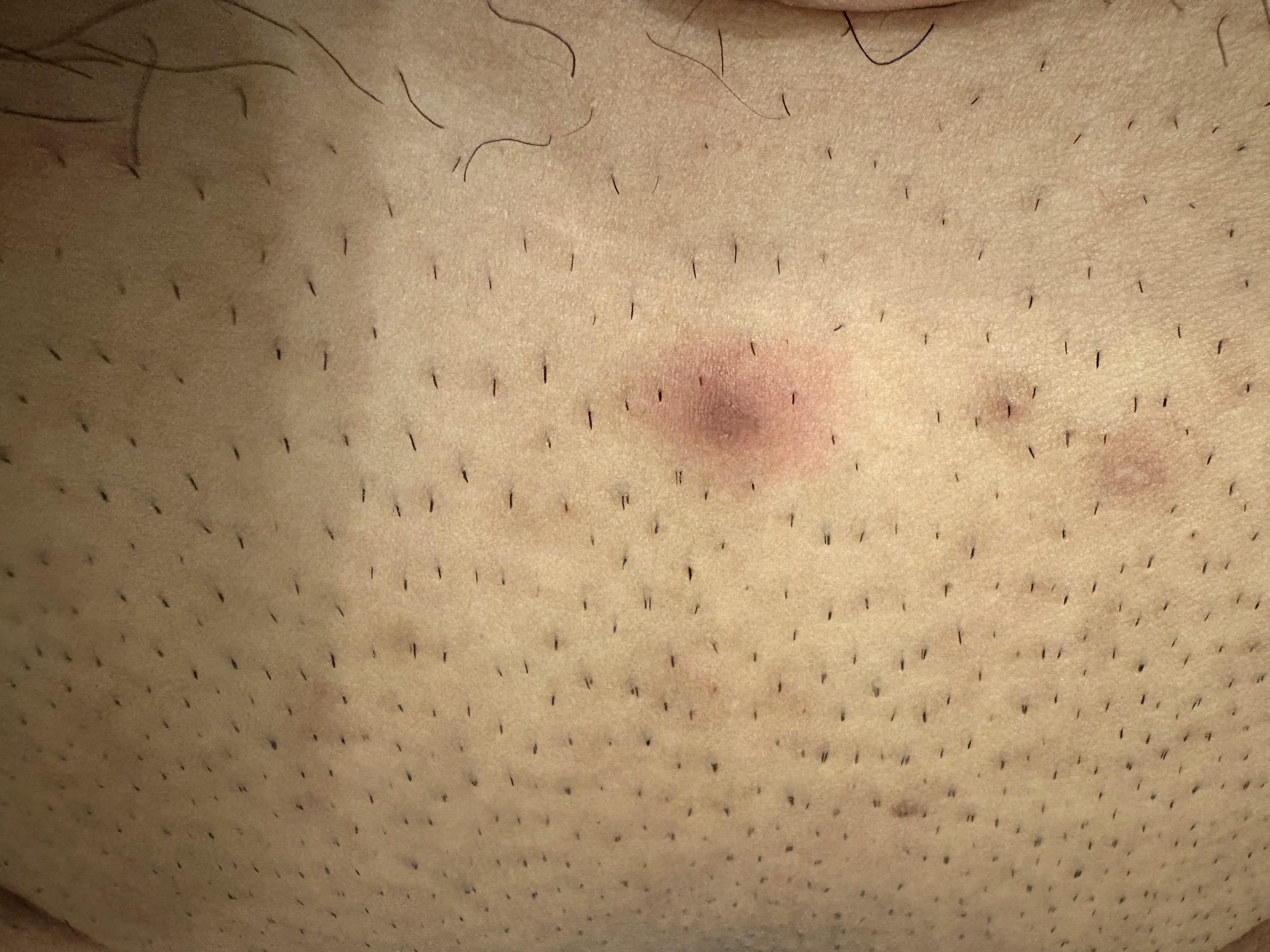 Pelo Enterrado Pelo Enquistado Como Eliminar El Vello De La Axila Esto Es  Un Vello Encarnado