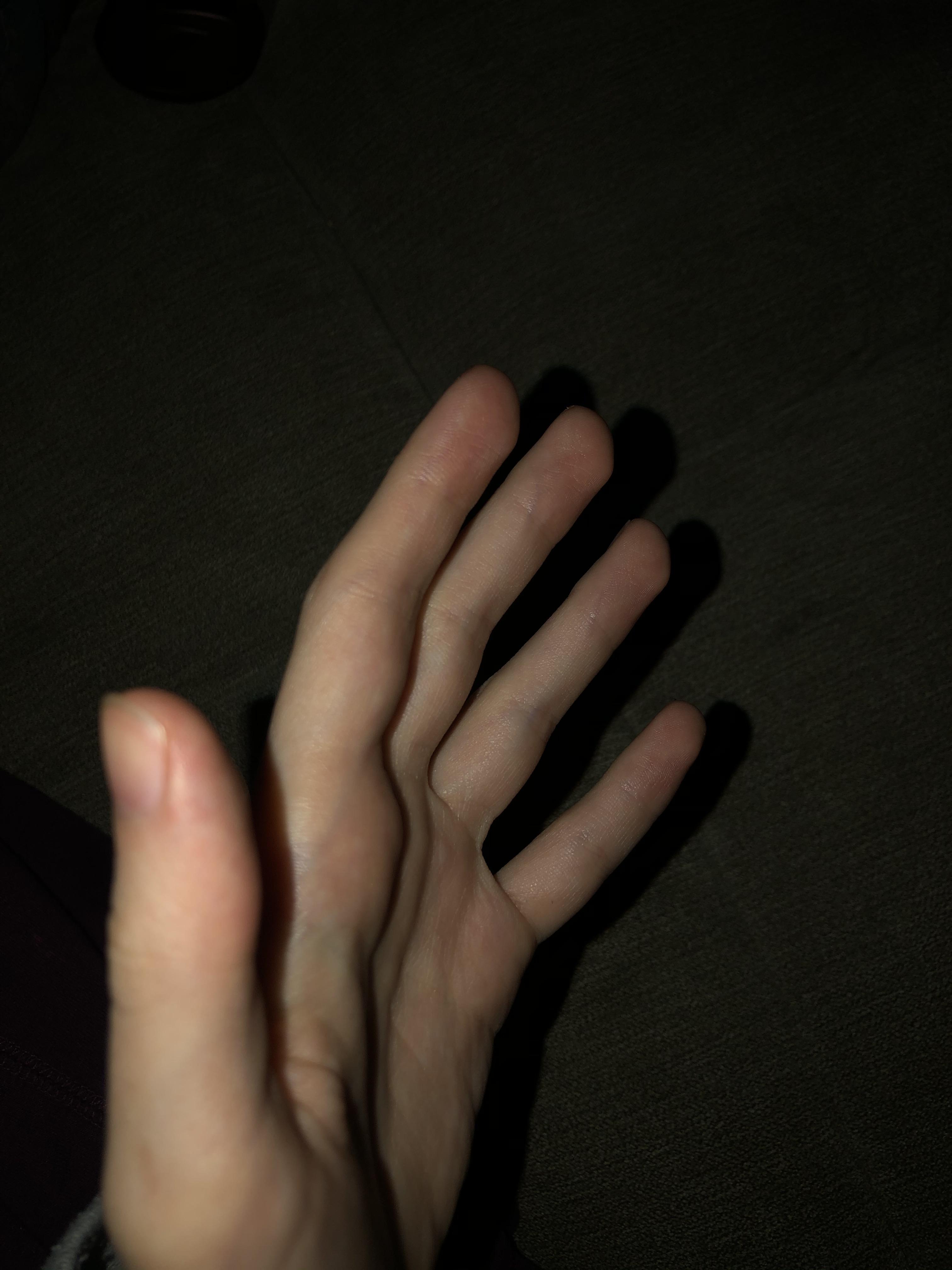 Why do my finger tips come to a point like this?