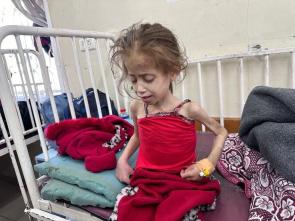 Starving girl. A doctor from an international aid agency took the picture 10th April at Kamal Adwan