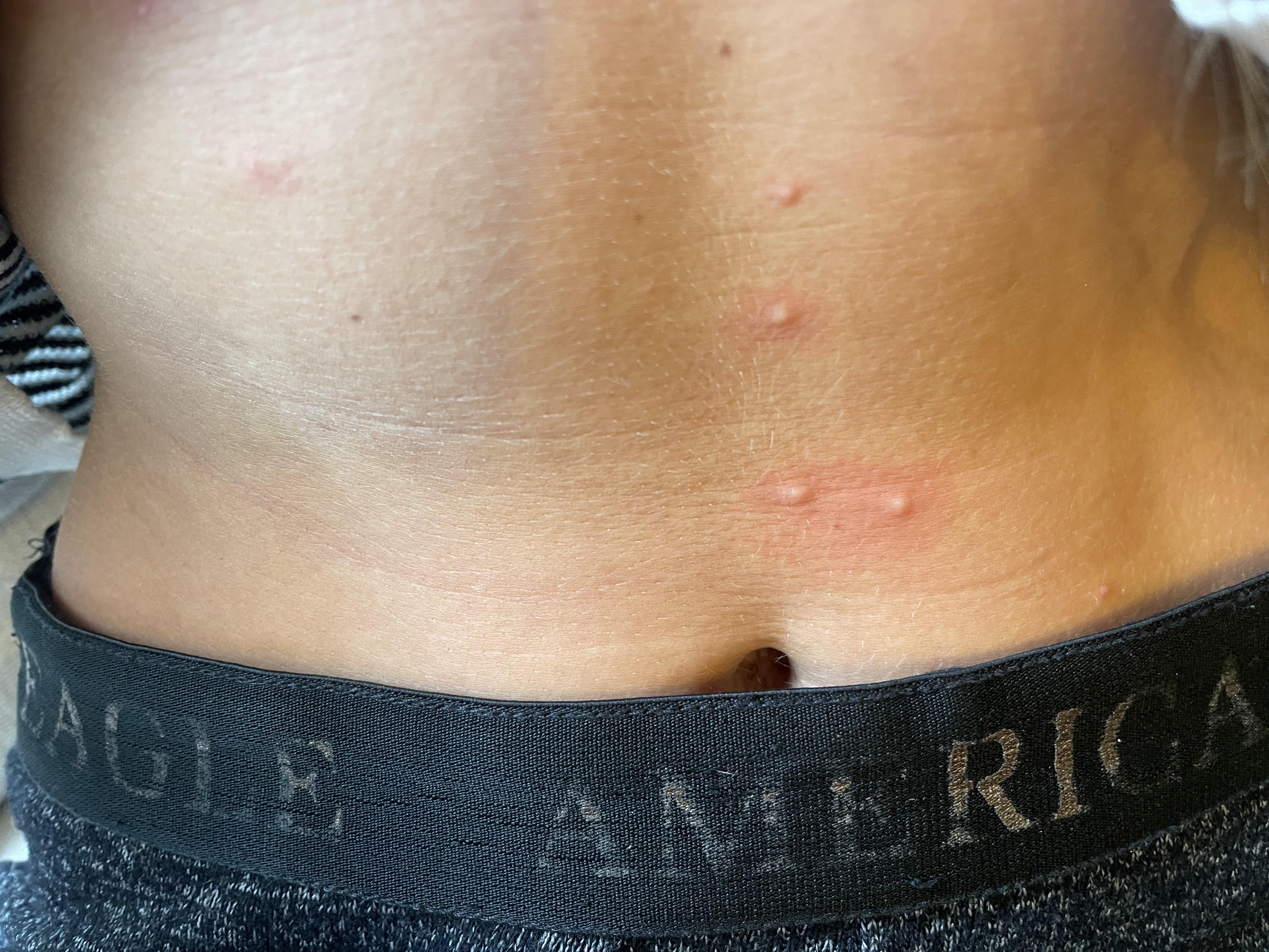 Chigger bites on stomach