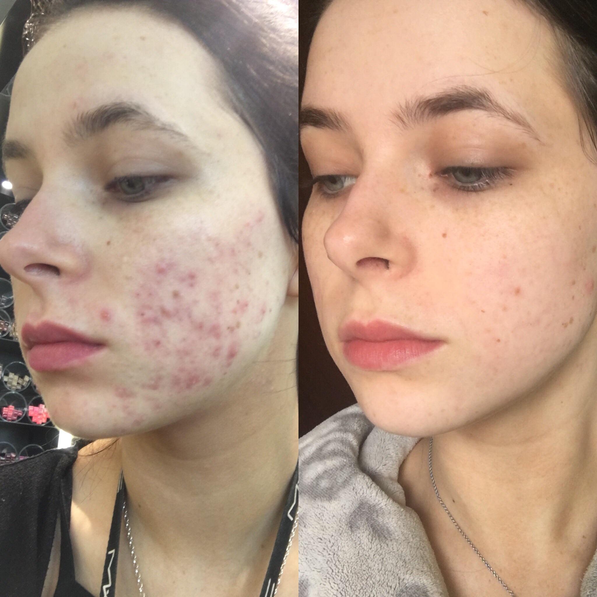 Accutane results