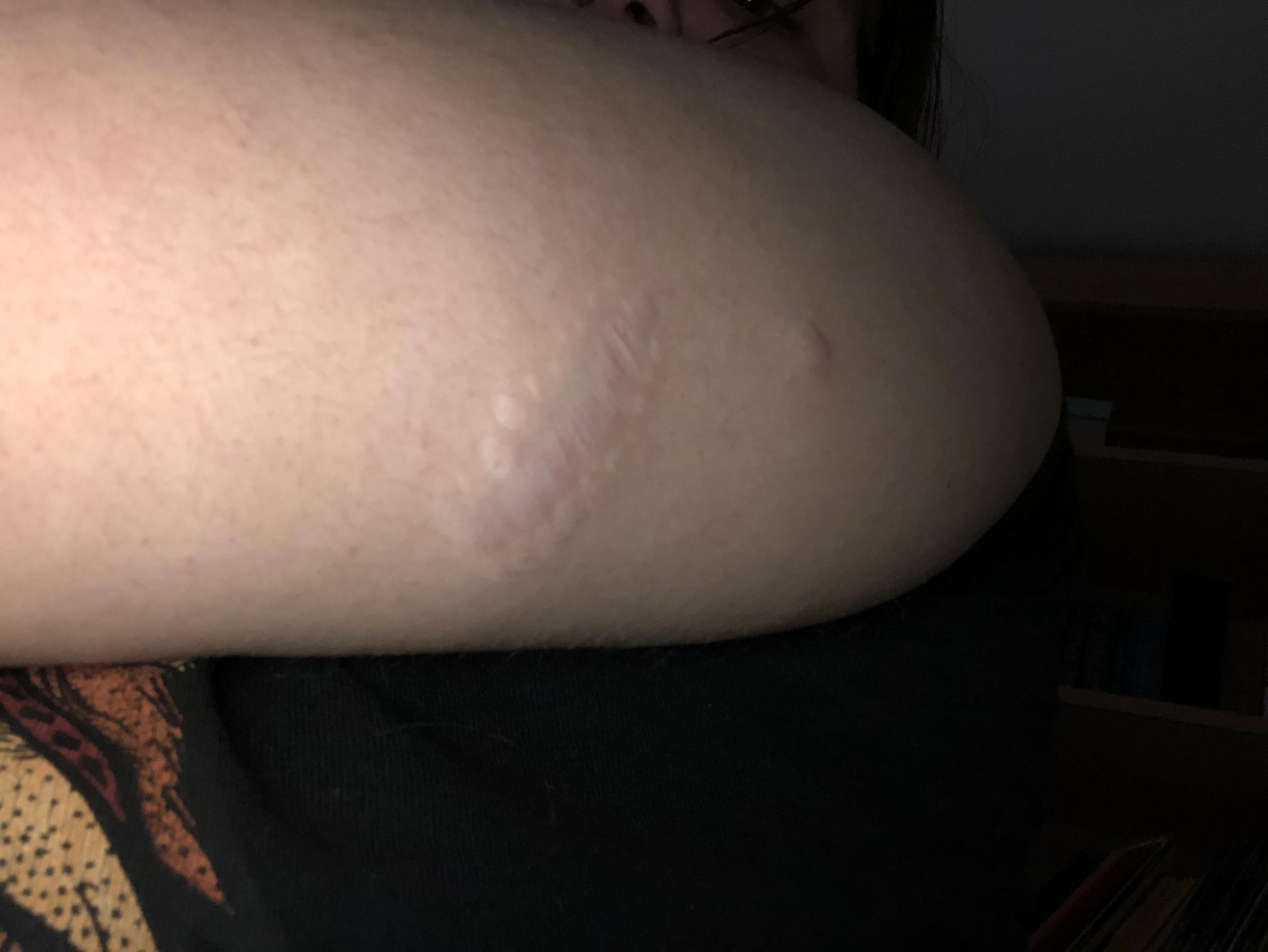 Car accident scar tattoo ideas? the car accident showed my cancer and i