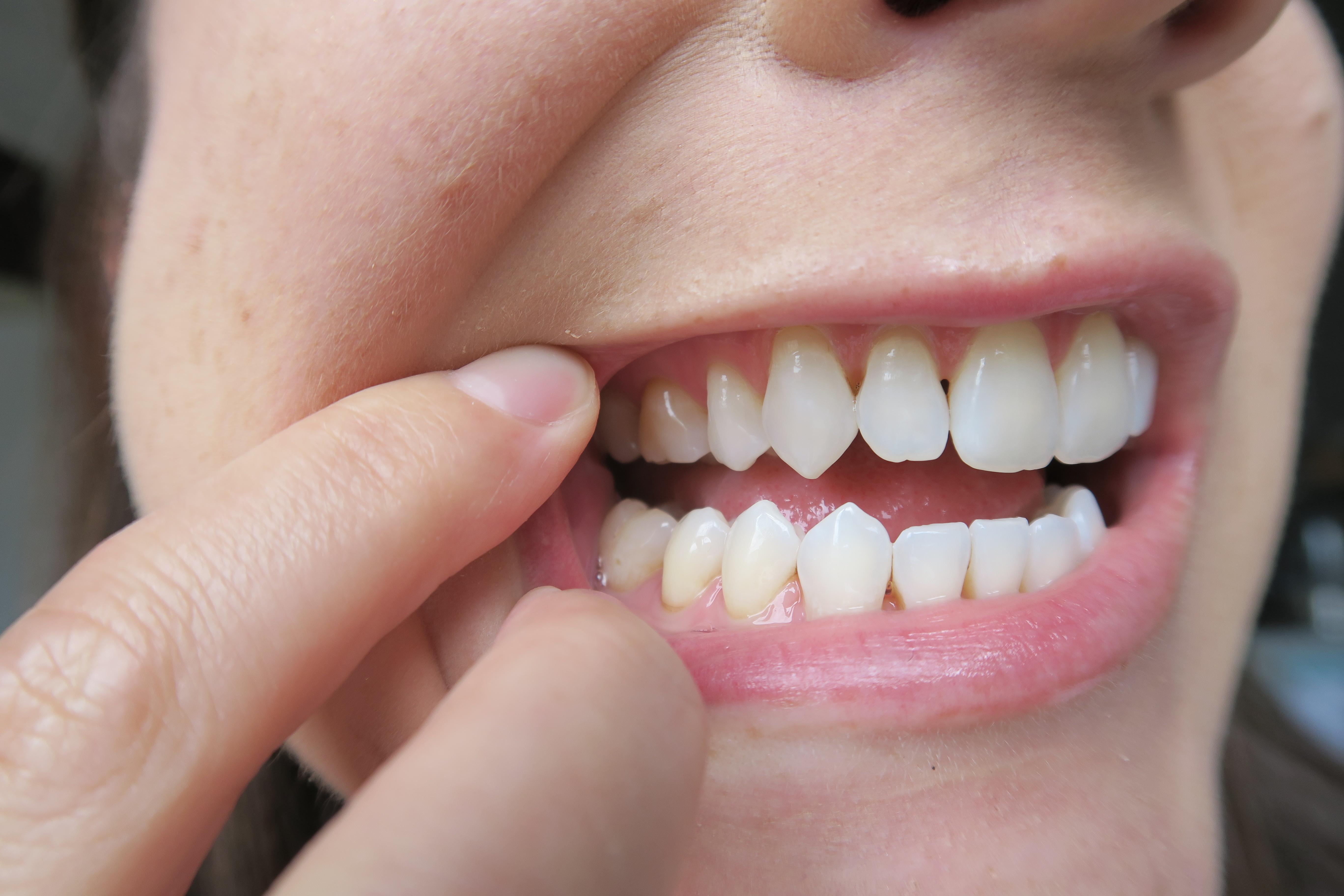 My gums bleed when i brush my teeth reddit