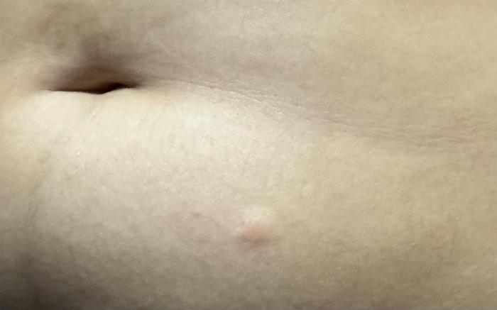 swollen injected area : r/Semaglutide A raised swollen well defined area on the skin