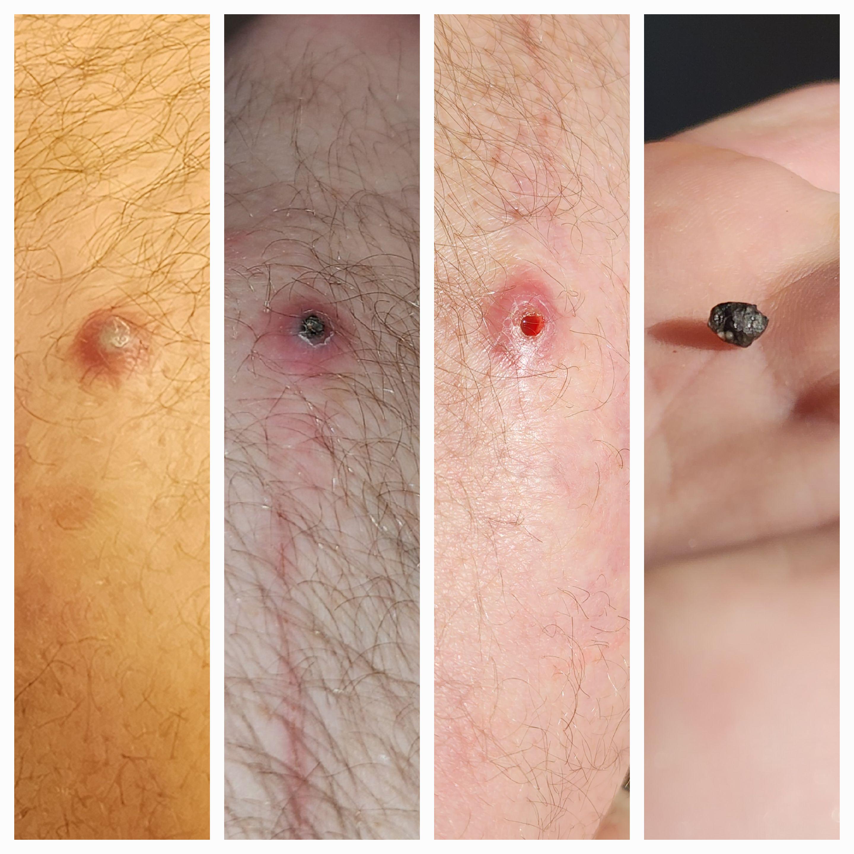 After 15 years, the rock in my arm finally came out. Nsfw :  rmildlyinteresting