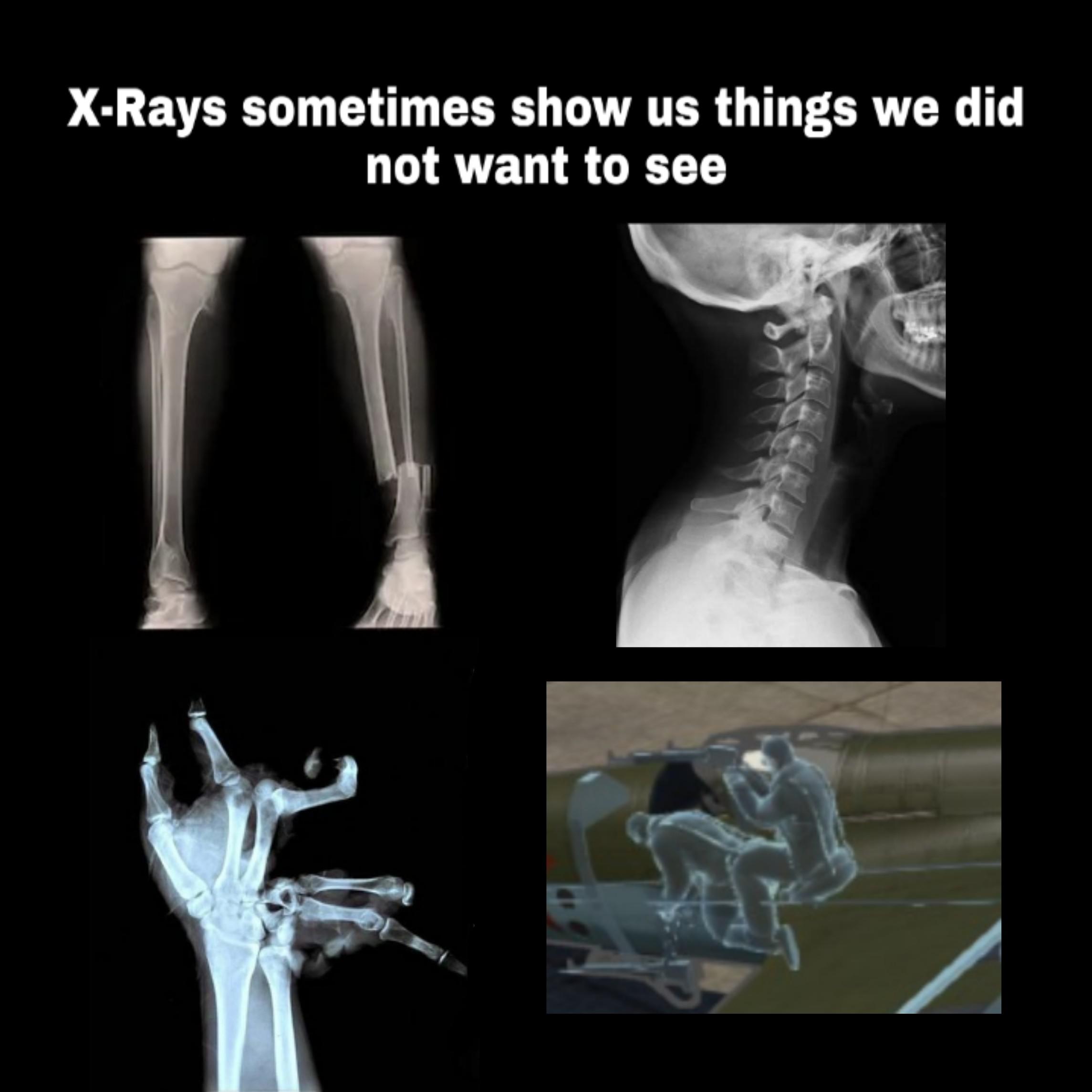 The Best 18 Funny Xray Memes sveltecozapics