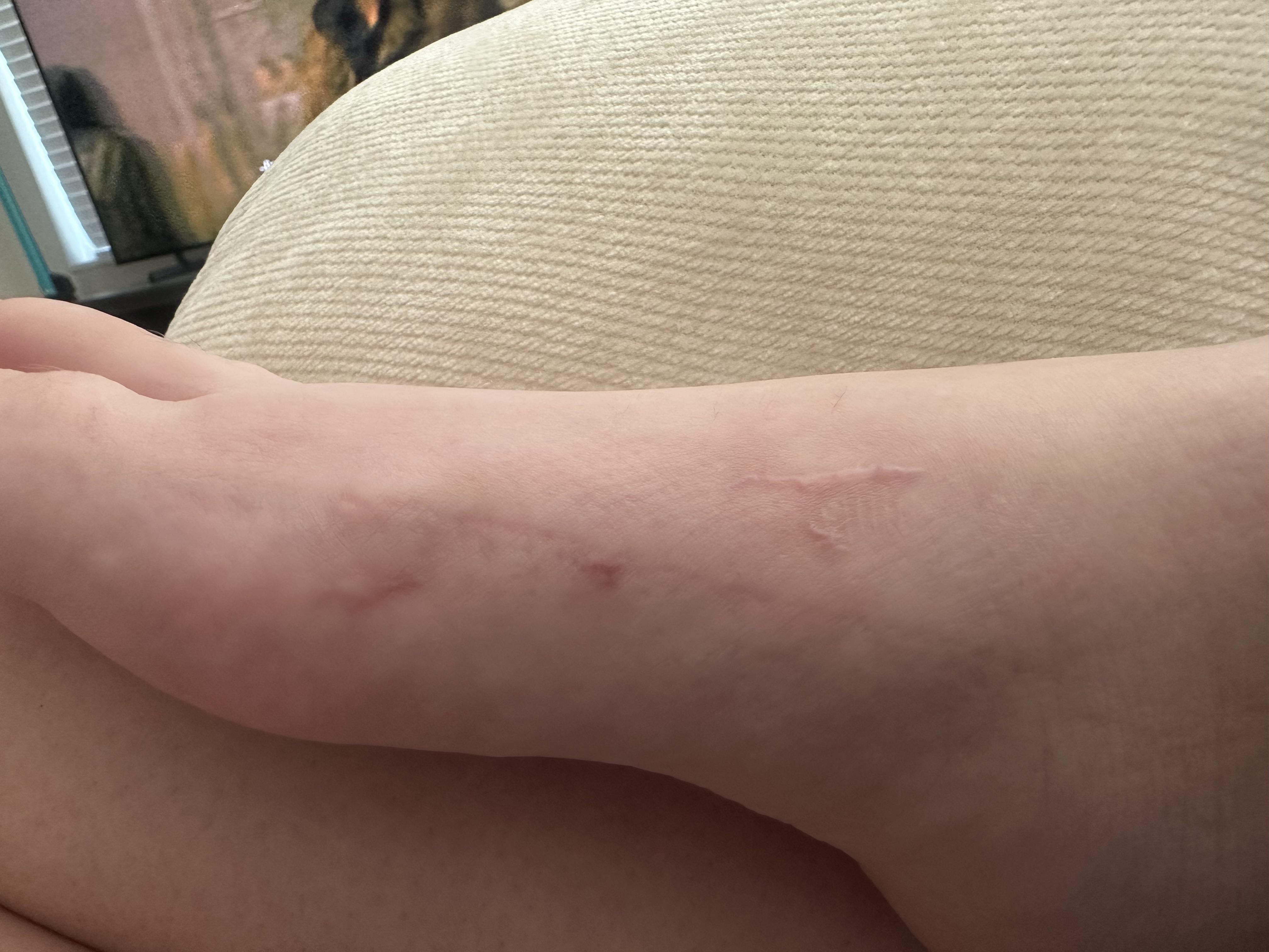 Curar una cicatriz facial reciente : rSkincare_Addiction