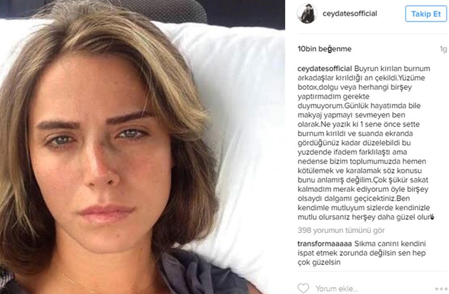 Burun Estetigi Yaptiran Unluler Elcin Sangu Burun Estetigi Yaptirdi Mi Genc Kalanlar