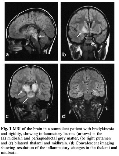 pics Encephalitis Lethargica Brain von economo auto immun