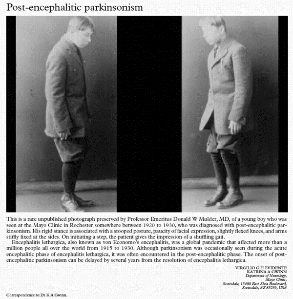 photo Philip Leather Encephalitis Lethargica von economo