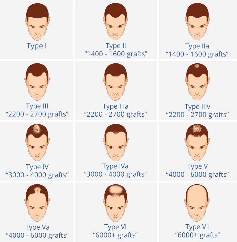 Male pattern hair loss