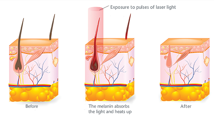 Lightsheer Laserontharing Boudrez Coiffure Beauty
