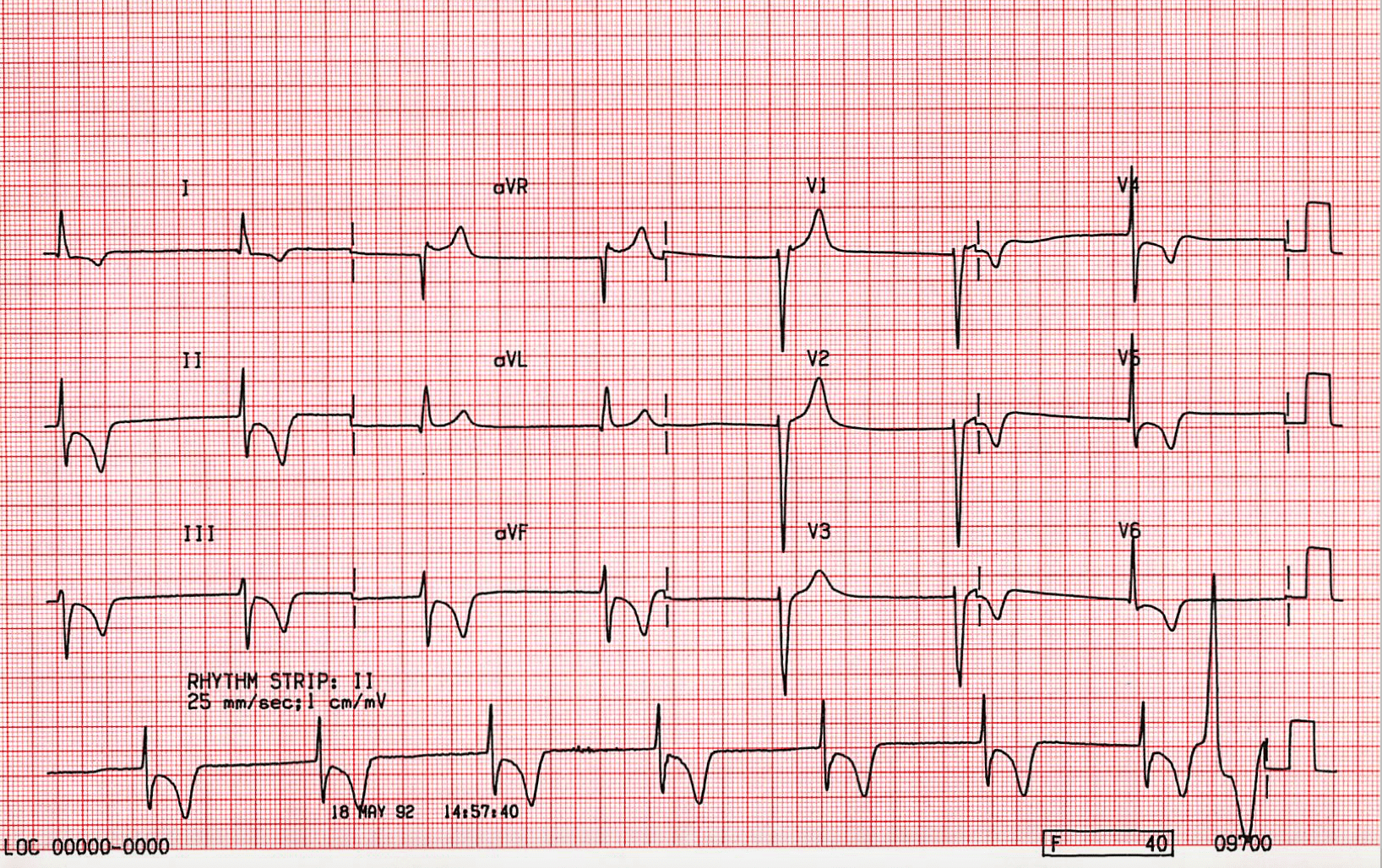 images Junctional Rhythm Ecg Strip st emlyn s