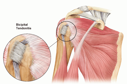 You also have biceps tendons that connect the biceps muscle to the shoulder bone. Ultrasound-Guided Injection Technique for Bicipital ...