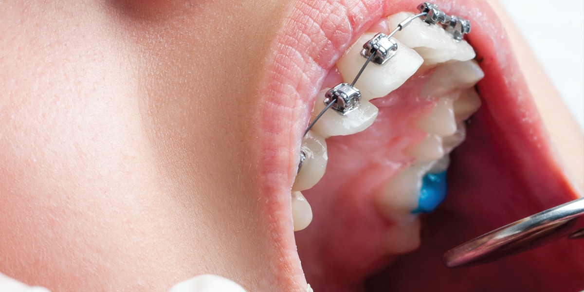 Hypersensitivity In Orthodontic Treatment Hypersensitivity In Orthodontic Treatment