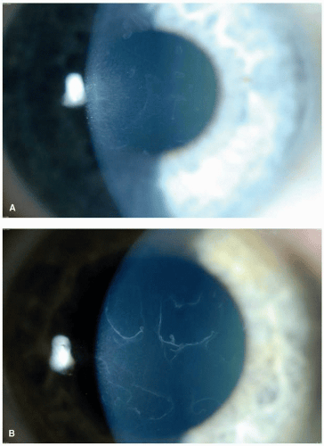 Map Dot Fingerprint Dystrophy C5 FF1 