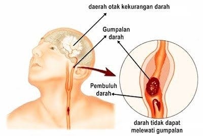 Darah Beku Di Kepala - dojoaki