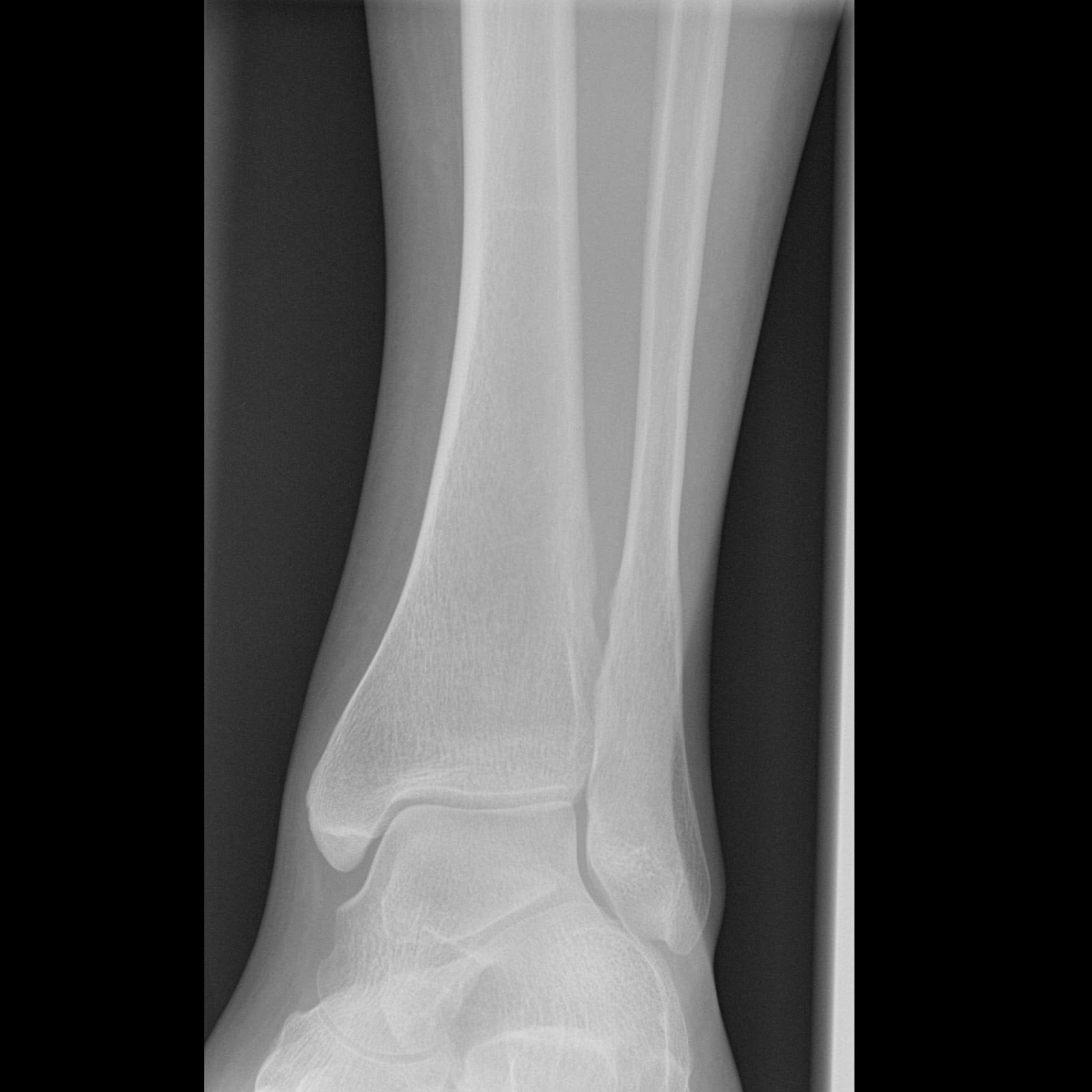 pic Ankle Sprain Ankle Xray t miss adult ankle and foot injuries