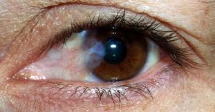 Occhio Alla Salute Oculare In Acqua Iapb Italia Onlus Agenzia Internazionale Per La Prevenzione Della Cecita