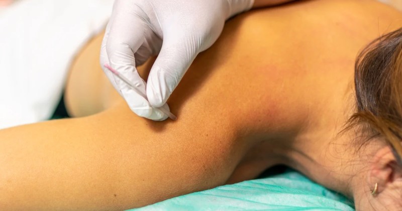 dry needling benefits