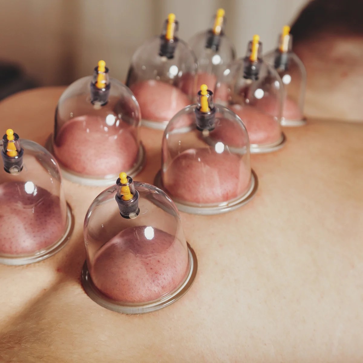 Cupping - icare Physical Therapy And Wellness