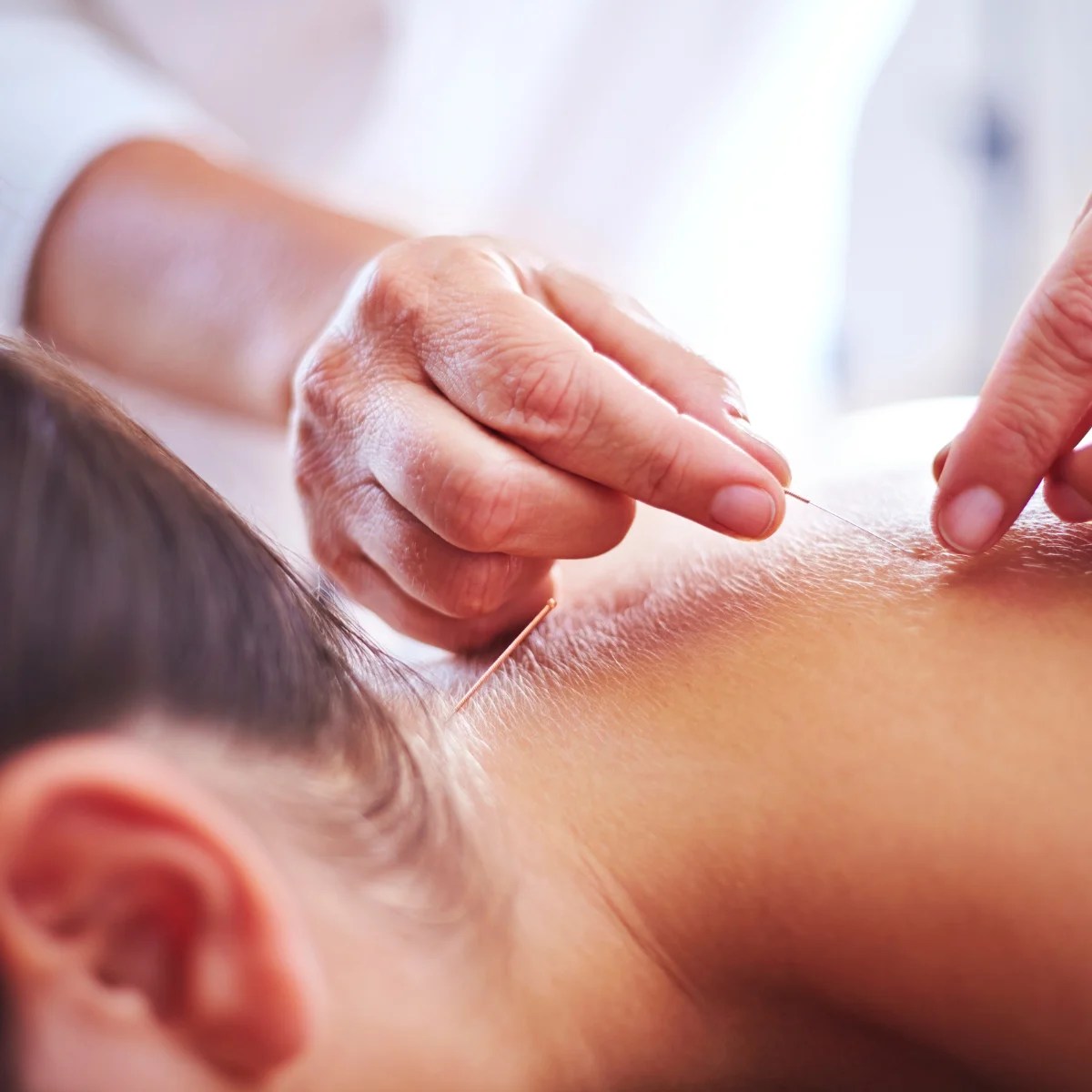 Dry Needling - icare Physical Therapy And Wellness