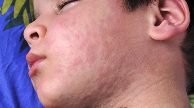 Der impfstoff schützt zugleich gegen masern, mumps und röteln. Hand-FuÃ-Mund-Krankheit: Symptome, Dauer & Ansteckung