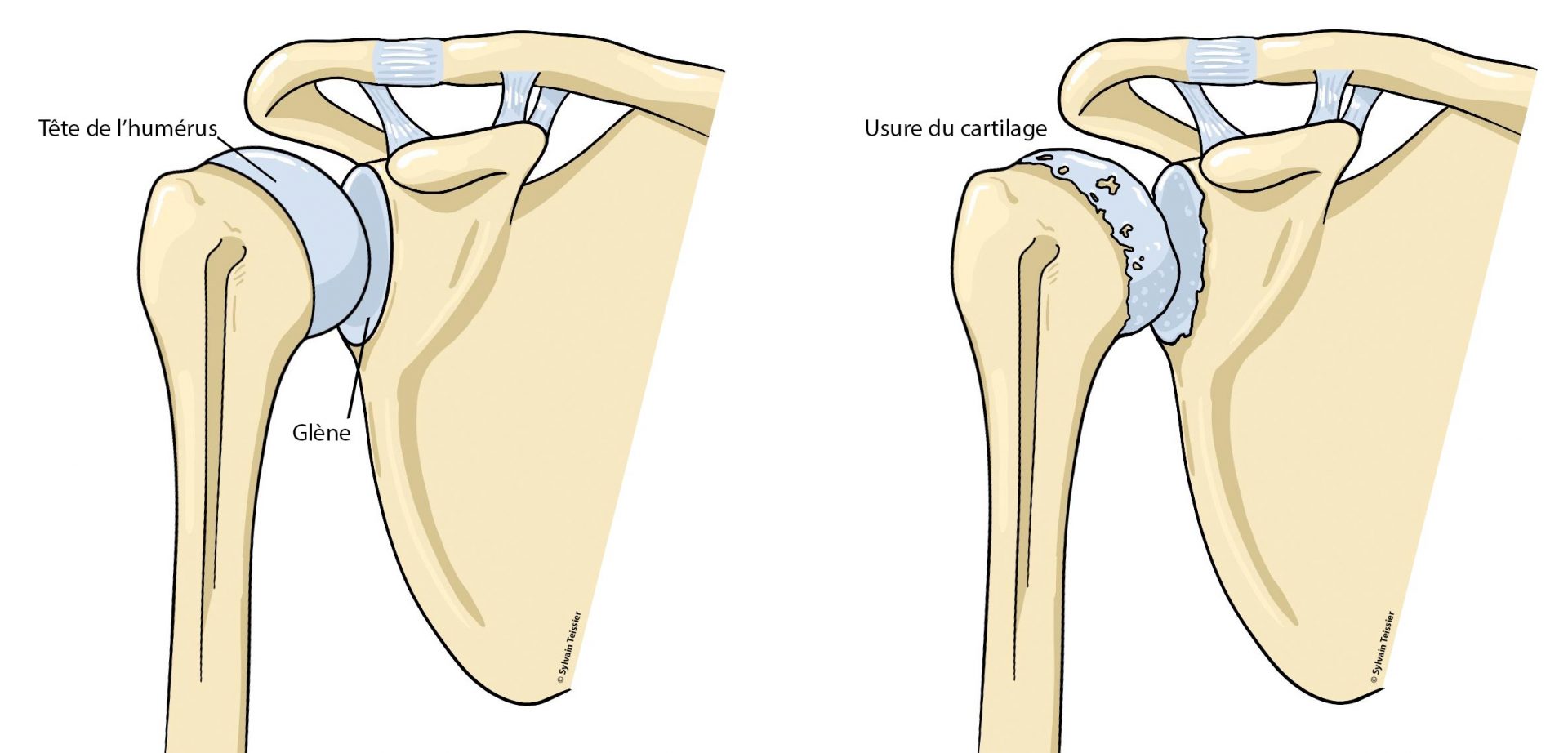 Arthrose de l'épaule