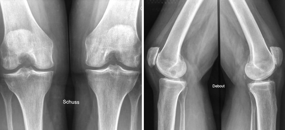 radiographie du genou