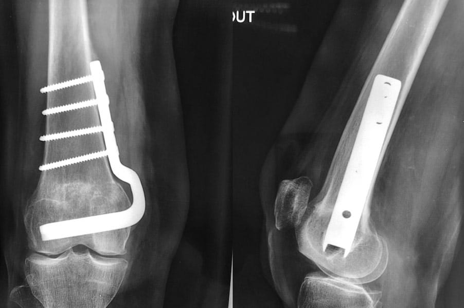 Arthrose externe