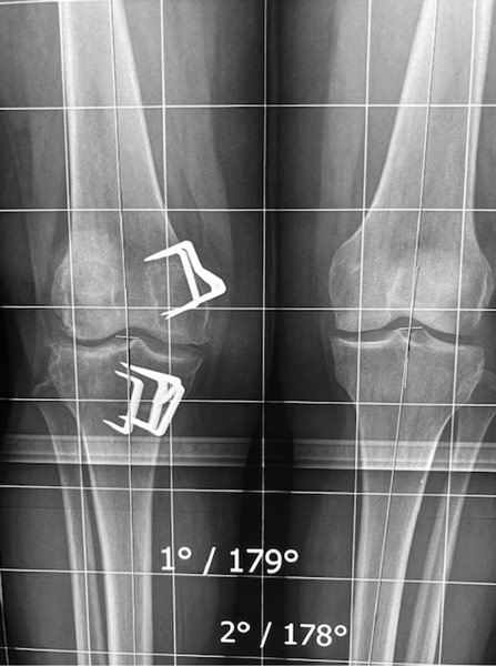 Déformation genou valgus